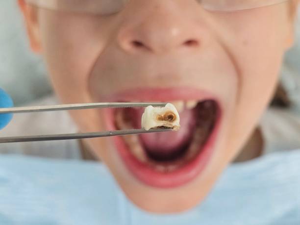 Best Emergency Wisdom Teeth Removal in Treasure Lake, PA